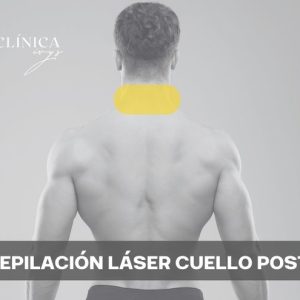 Depilación Láser Cuello Posterior